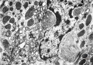 M,38y. | fibrillary astrocytoma